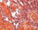 Multifocal lymphangioendotheliomatosis