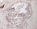 Multifocal lymphangioendotheliomatosis (D2-40)