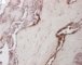 Multifocal lymphangioendotheliomatosis with thrombocytopenia (...)