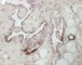 Multifocal lymphangioendotheliomatosis with thrombocytopenia (...)