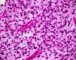 myxoid embryonal rhabdomyosarcoma (Orbit)