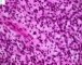 myxoid embryonal rhabdomyosarcoma (Orbit)