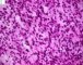 myxoid embryonal rhabdomyosarcoma (Orbit)
