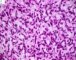 Embryonal rhabdomyosarcoma