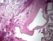 pleuropulmonary blastoma type 1