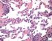 Retiform hemangioendothelioma