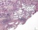 Retiform hemangioendothelioma