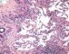 Retiform hemangioendothelioma