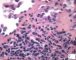 Retiform hemangioendothelioma