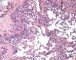 Retiform hemangioendothelioma