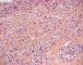 Sclerosing rhabdomyosarcoma