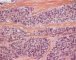 Sclerosing rhabdomyosarcoma