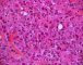 Syncitial classic Hodgkin lymphoma