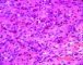 Syncitial classic Hodgkin lymphoma