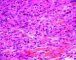 Syncitial classic Hodgkin lymphoma