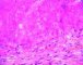 Syncitial classic Hodgkin lymphoma