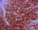 CD15 - Syncitial classic Hodgkin lymphoma