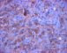 CD30 - Syncitial classic Hodgkin lymphoma
