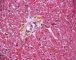 Thrombotic microangiopathy