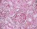 Thrombotic microangiopathy