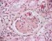 Thrombotic microangiopathy