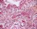 Thrombotic microangiopathy