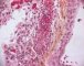 Thrombotic microangiopathy