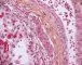 Thrombotic microangiopathy