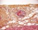 Thrombotic microangiopathy