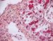 Thrombotic microangiopathy