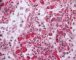 Thrombotic microangiopathy