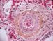 Thrombotic microangiopathy