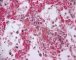 Thrombotic microangiopathy