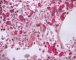 Thrombotic microangiopathy