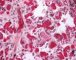 Thrombotic microangiopathy