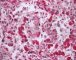 Thrombotic microangiopathy