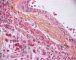 Thrombotic microangiopathy