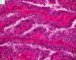 Thyroid papillary carcinoma