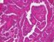 Thyroid papillary carcinoma