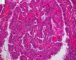 Thyroid papillary carcinoma