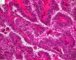 Thyroid papillary carcinoma
