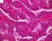 Thyroid papillary carcinoma