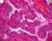 Thyroid papillary carcinoma