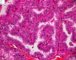 Thyroid papillary carcinoma