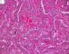 Thyroid papillary carcinoma