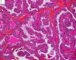 Thyroid papillary carcinoma