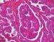 Thyroid papillary carcinoma