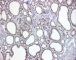 TTF-1 labelling in infantile thyroid
