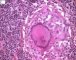 Langhans cell in tuberculoid granuloma