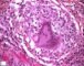 Langhans cell in tuberculoid granuloma